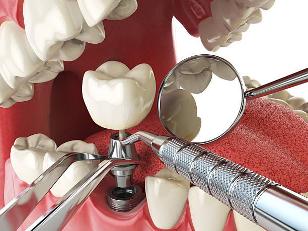 Best Emergency Root Canal Treatment in Garrison, ND